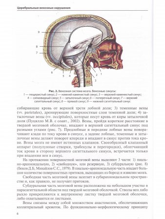 Церебральные венозные нарушения