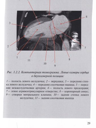 Лучевая диагностика кардиомиопатий