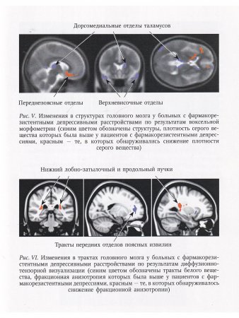 Функциональная нейрохирургия в лечении нервных и психических заболеваний