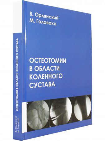 Остеотомии в области коленного сустава