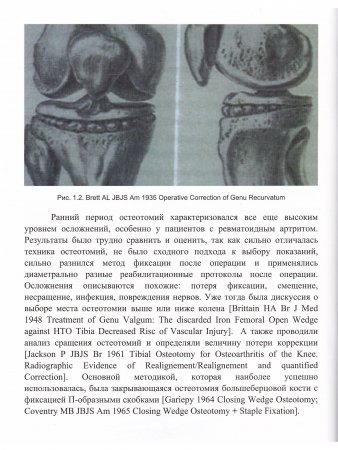 Остеотомии в области коленного сустава